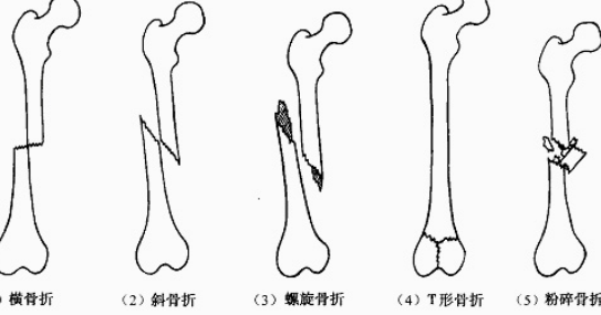 图片[2]-【每日一骨】膝关节之胫骨