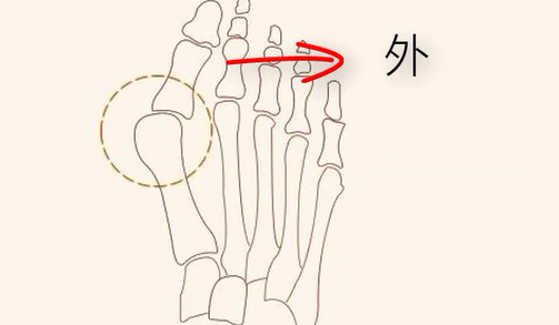 图片[2]-【每日一骨】拇外翻的形成原因与矫正方法